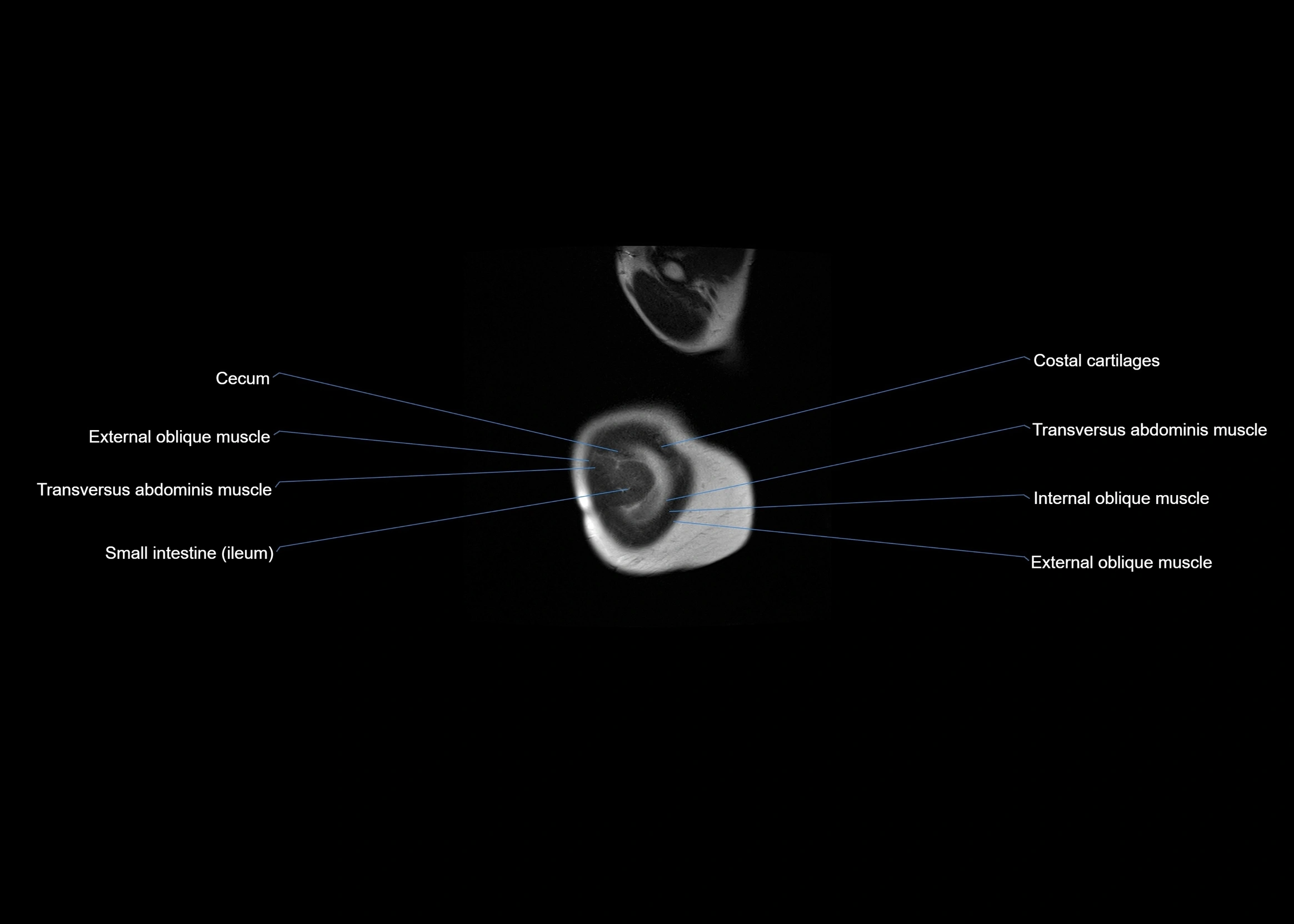 MRI abdomen sagittal cross sectional anatomy  radiology  image-img-00001-00002.webp